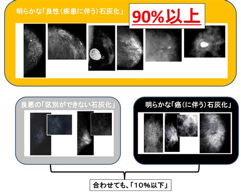 微細石灰化の集簇|乳がん検診で見つかる「石灰化」とは？ 乳がんの確率や精密検。